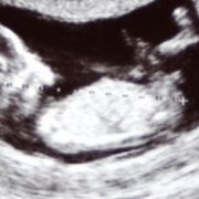 Troisième échographie de grossesse
