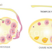 ovaire polykystique kyste aux ovaires