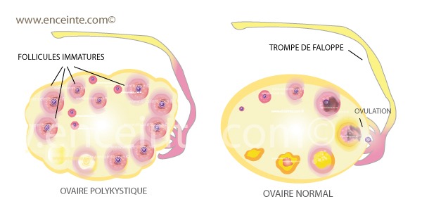 ovaire polykystique kyste aux ovaires