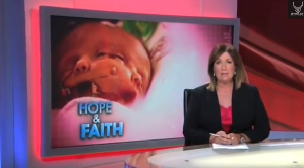 Des jumelles nées avec un corps et deux visages